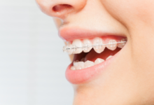 4 Options to Fix Crooked Teeth