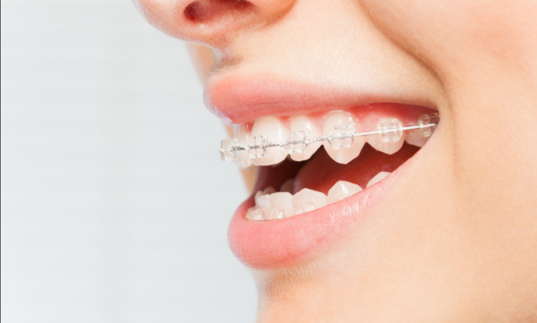 4 Options to Fix Crooked Teeth